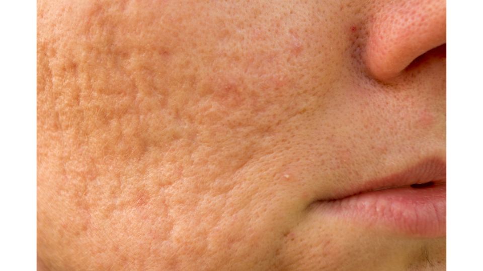 Close-up of a girl with problematic skin and visible acne scars showing common acne scar types
