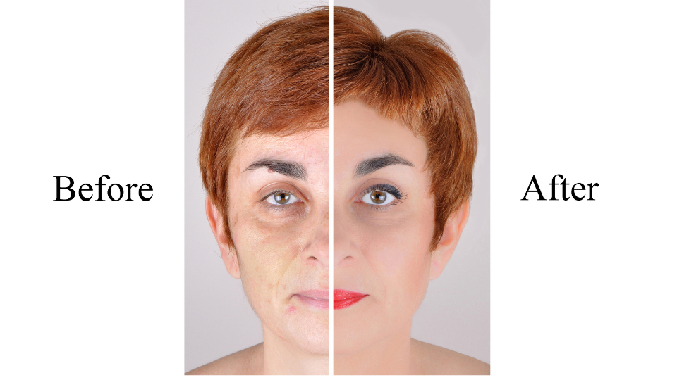Woman before and after acne scar treatment showing visible skin improvement – acne scar treatment guide
